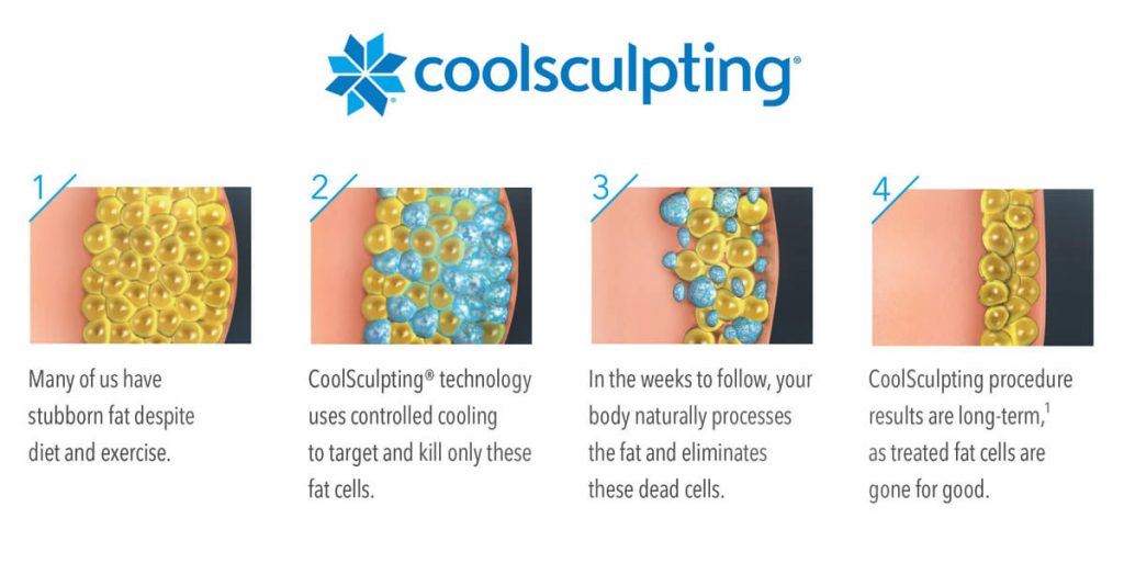 Coolsculpting process
