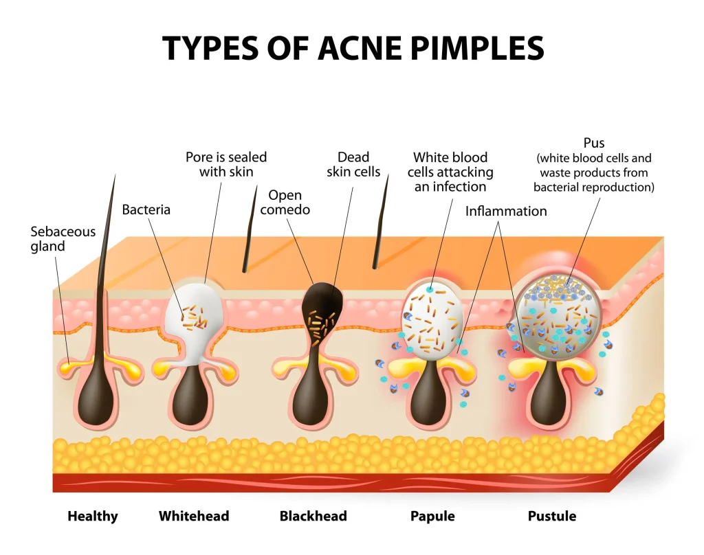 Types of acne