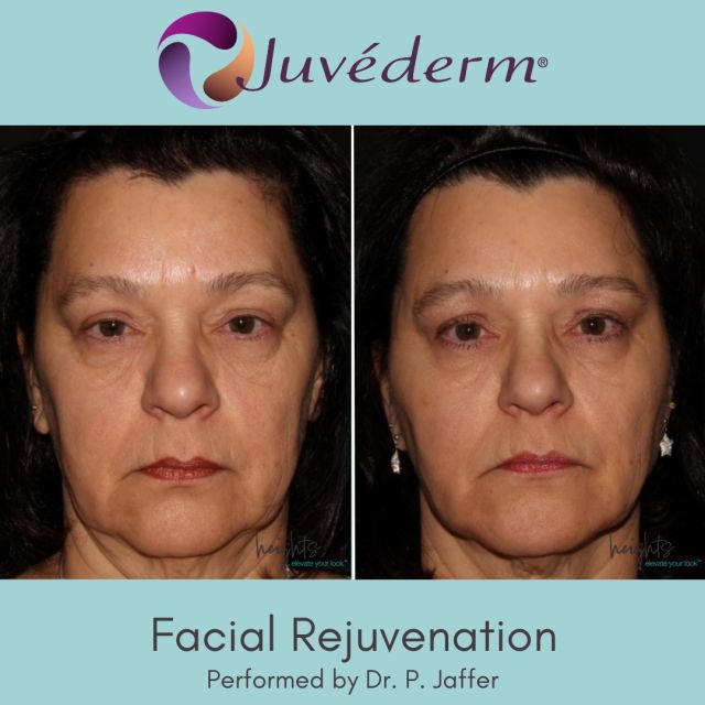 Transforming lives, one syringe at a time. Witness the power of full-face rejuvenation with JUVÉDERM® fillers done by Dr. Jaffer. ✨ 

Don't miss out to double your Brilliant Distinctions points when doing JUVÉDERM® and BOTOX® together in a combined treatment! 

Call to book now:
T: (604) 298-4481
E: info@heightslaser.com
.
.
.
.
.
.
.
#NaturalRadiance #ConfidenceRestored