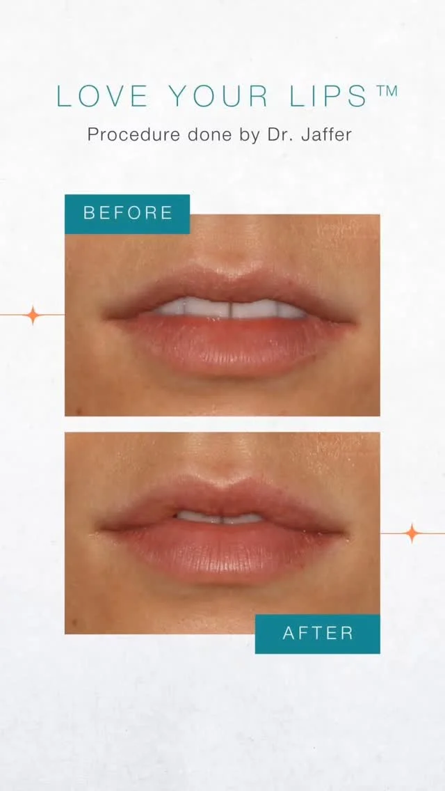 Love Your Lips™ by Dr. Jaffer at Heights Laser Centre in Burnaby Heights.

A conservative, medical-led approach for first-timers who want their lips, just better,  soft, balanced, and undetectable.

Complimentary consultation available.
