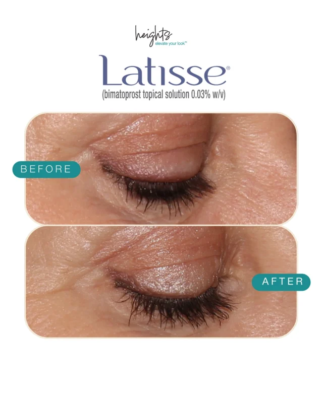 ✨Natural lash lovers this one’s for you! ✨

Celebrate National Lash Day with naturally longer, fuller lashes using Latisse 👁️✨

At Heights Laser Centre, we love Latisse because it’s clinically proven to:
✔️ Promote longer lashes
✔️ Increase thickness & darkness
✔️ Enhance your natural lashes, no extensions needed

Book your complimentary consultation in North Burnaby and start your lash growth journey today 💕
📍 Conveniently located in the Burnaby Heights