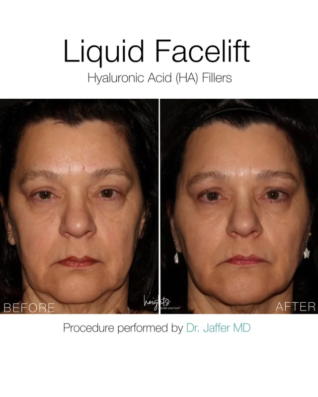 Before & After | Liquid Facelift with Hyaluronic Acid (HA) Fillers

Strategic placement of hyaluronic acid dermal fillers can help restore facial structure, support areas of volume loss, and soften deeper folds associated with aging.

This approach, often referred to as a “liquid facelift” focuses on subtle structural support rather than overfilling. By addressing key areas of the face, the goal is to refresh and rebalance facial proportions while maintaining natural movement and expression.

Dr. Jaffer’s philosophy centers on timeless, balanced enhancement. Results that look refreshed, never overdone.

Procedure performed by Dr. Jaffer.

📍 Heights Laser Centre
Burnaby, BC

Book your complimentary consultation to learn whether injectable treatments may be appropriate for you.

🔗 Link in bio to book.

Important:
All injectable treatments should be performed by a licensed and properly trained medical professional. Individual results may vary. A consultation is required to determine appropriate treatment options.