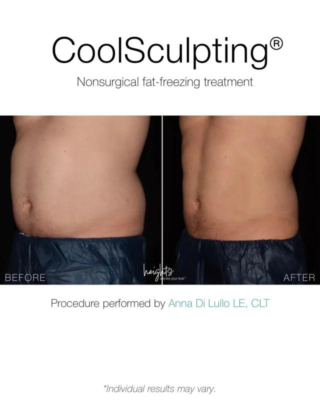 Stubborn abdominal fat that won’t budge?

This patient came to us seeking body contouring in Burnaby to target his abdomen and flanks.

After a personalized consultation with our laser technician, a customized plan using CoolSculpting® was recommended to treat both areas for a more balanced, sculpted result.

Using controlled cooling technology, CoolSculpting works to permanently reduce fat cells in treated areas, with no surgery and no downtime.

The result?
A more defined midsection, achieved gradually and naturally.

Case Breakdown:
– Treatment: CoolSculpting® (body contouring)
– Areas treated: Abdomen + flanks (love handles)
– Plan: 2 sessions
– Cycles: Abdomen (4) | Flanks (4 per side)
– Goal: Reduce stubborn fat + improve contour
– Outcome: Visible fat reduction and a more sculpted silhouette

Because the right treatment plan makes all the difference.

📍3992 Hastings Burnaby
🔗 Book your consultation

—

#CoolSculptingBurnaby #BodyContouringVancouver #FatReductionBC #CoolSculptingResults

*Individual results may vary. Not a weight loss treatment.